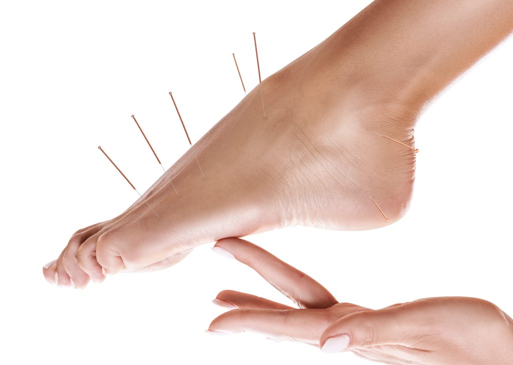 Image shows foot inserted with acupuncture needles.