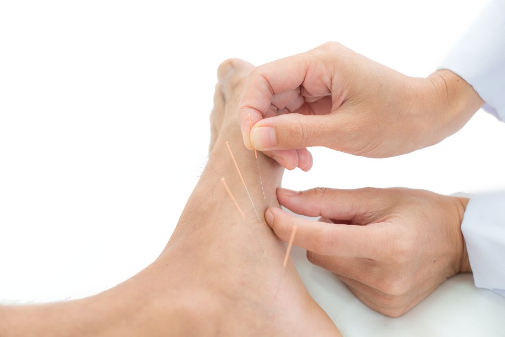 Image shows a physiotherapist performing dry needling on man's foot.
