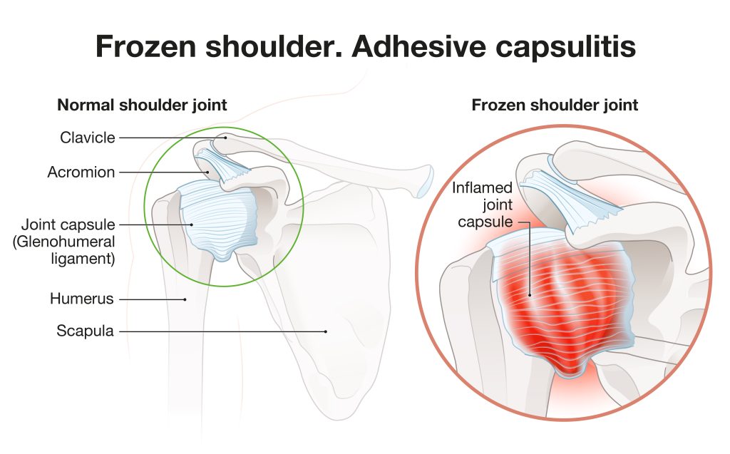 Image shows illustration of shoulder anatomy and how frozen shoulder happens.