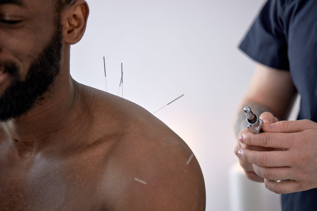 Black man with acupuncture needles inserted on his shoulders and back