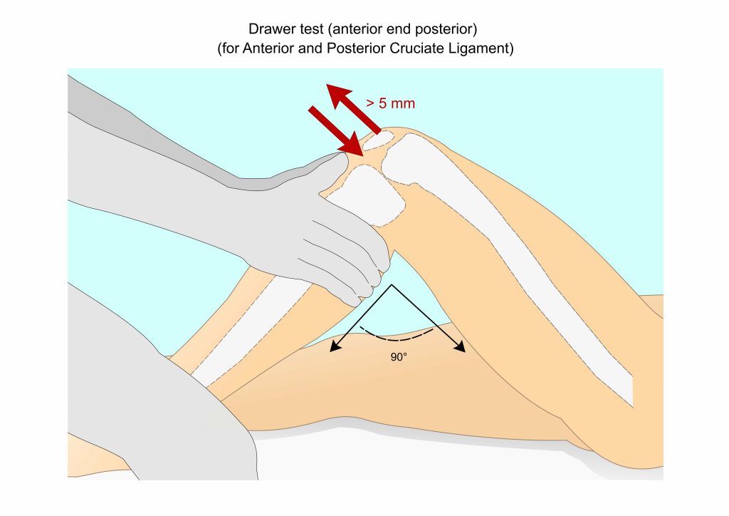 Anterior and Posterior drawer maneuver to test knee integrity of acl and pcl