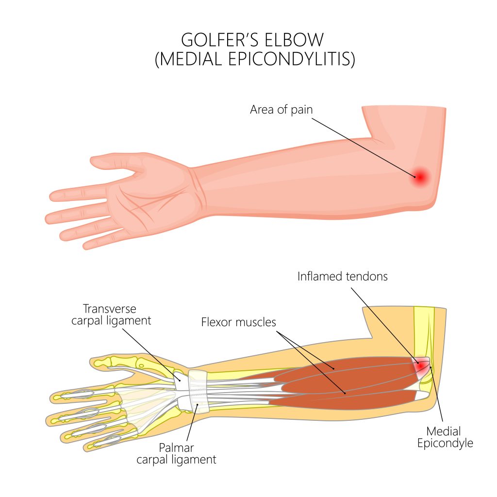 Image shows golfer's elbow injury