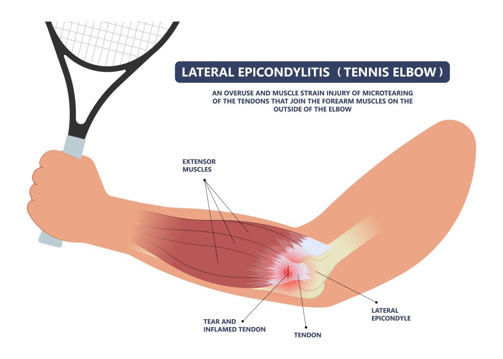 An illustration of tennis elbow injury