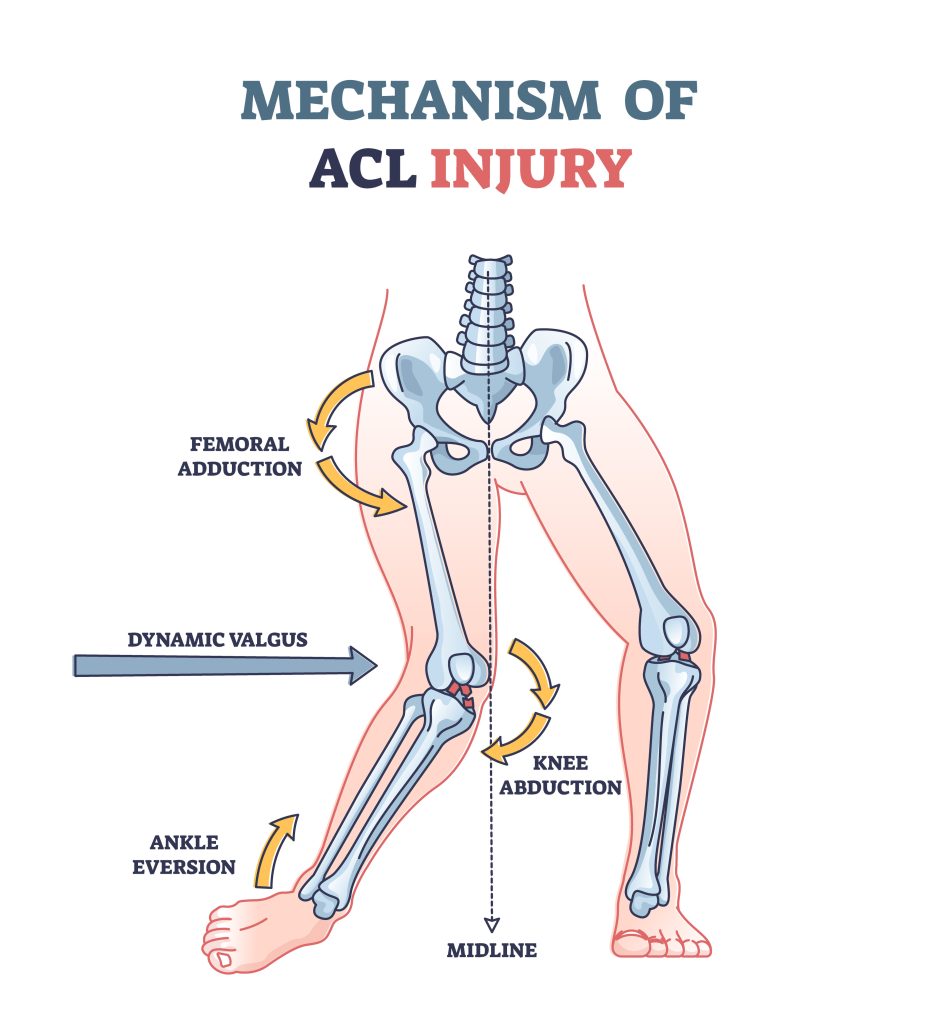 diagram explains mechanism of acl injury