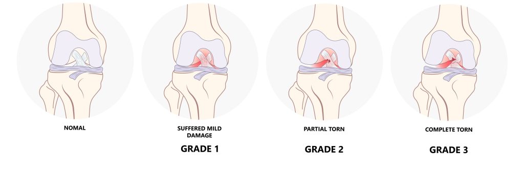 Classification of severity of acl/pcl injuries