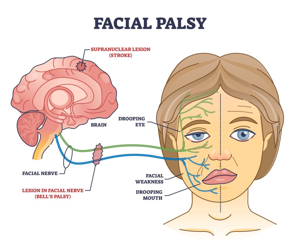 Labelled muscle weakness on bell's palsy due to nerve damage.