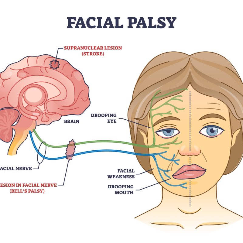 Labelled muscle weakness on bell's palsy due to nerve damage.