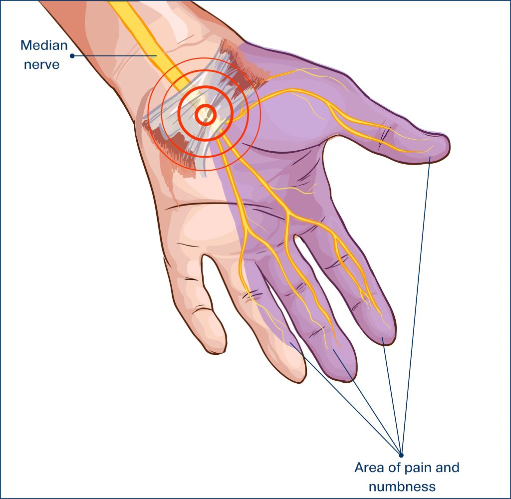 illustration of area of pain and numbness when median nerve is compressed