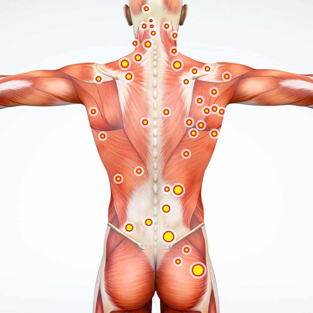 Illustration of myofascial trigger points that can be treated with dry needling.