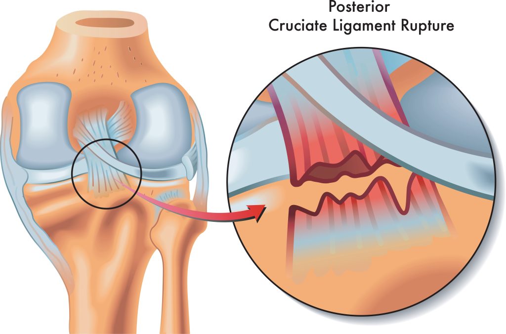 Image shows posterior cruciate injury