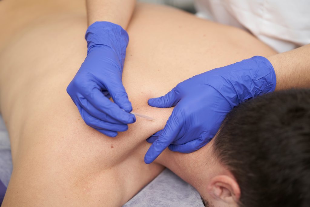Physical therapist treating myofascial pain with dry needling