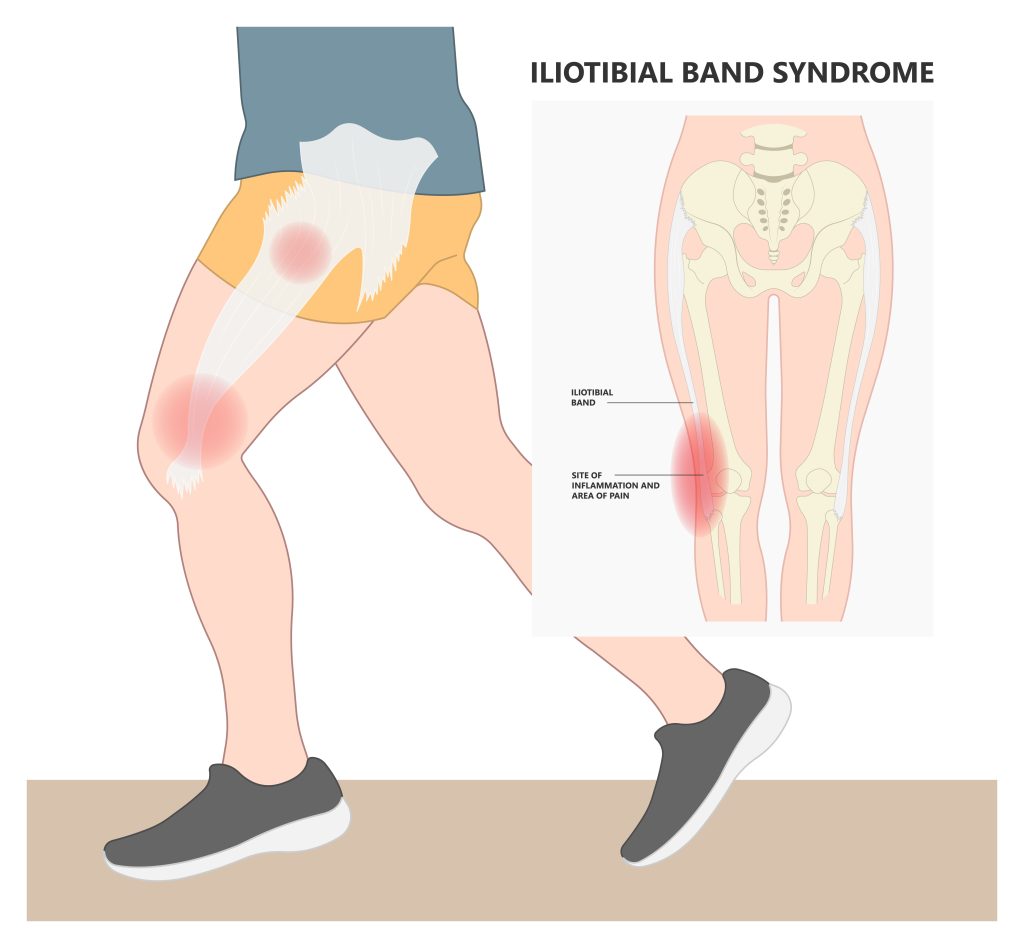 Illustration of iliotibial band and how it leads to iliotibial band syndrome.