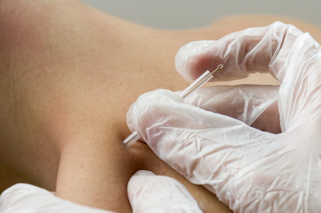 Close-up illustration of needle used in dry needling.