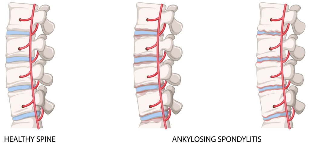 Illustration of a healthy spine and a spine with ankylosing spondylitis.