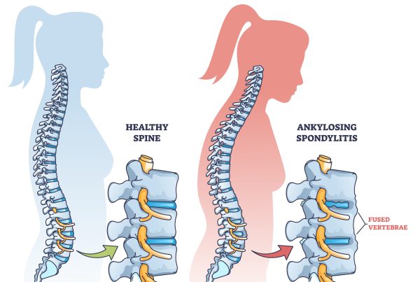 Outline diagram for ankylosing spondylitis.