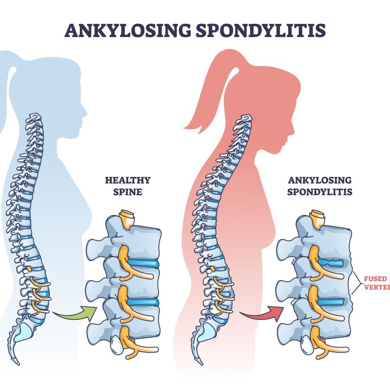 Outline diagram for ankylosing spondylitis.