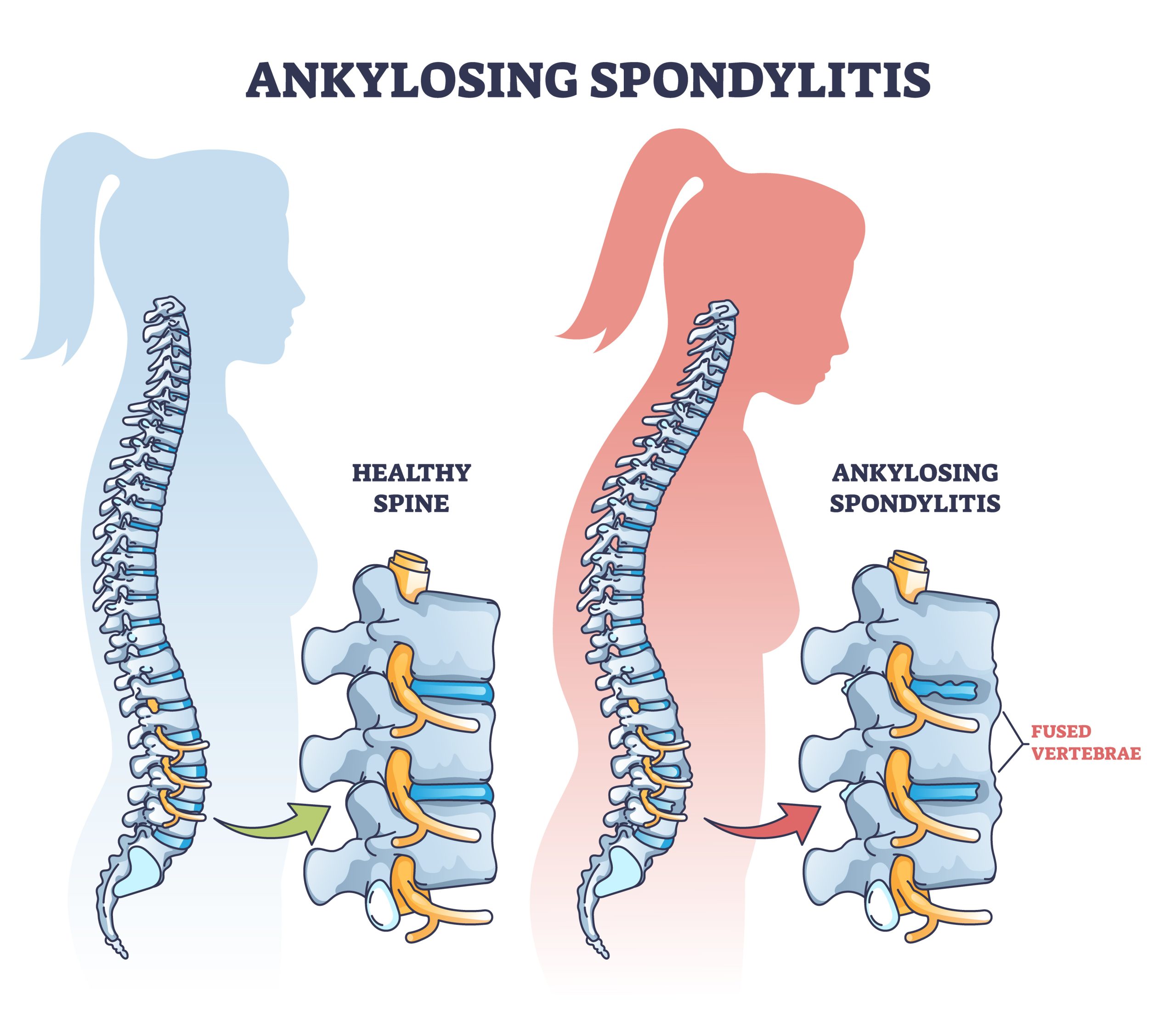 Outline diagram for ankylosing spondylitis.