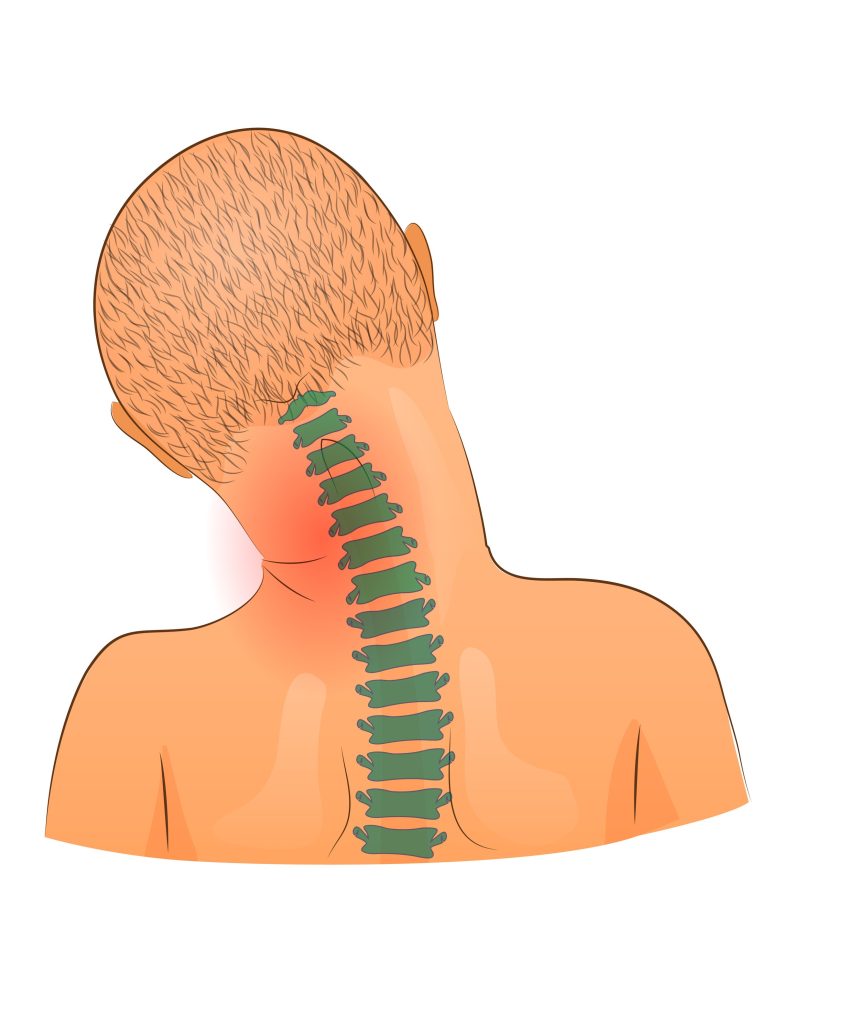 spastic torticollis in a child