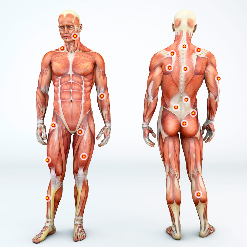Illustration of trigger points in the body for myofascial pain syndrome.