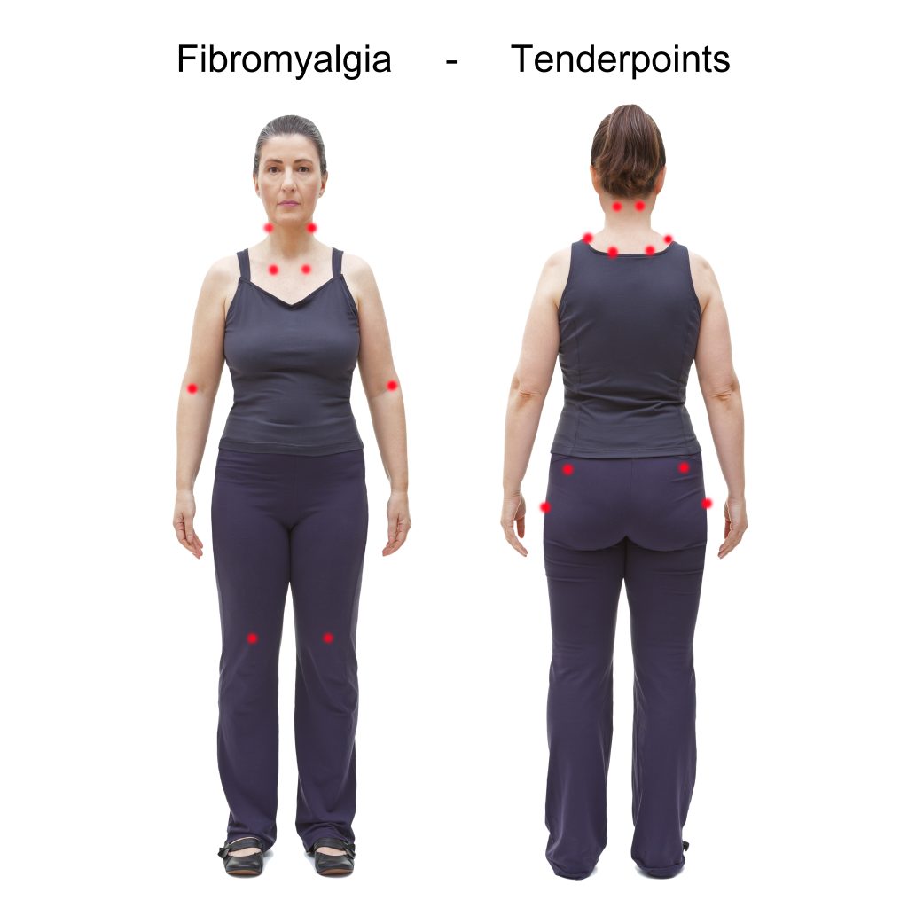 Illustration of fibromyalgia tender points.