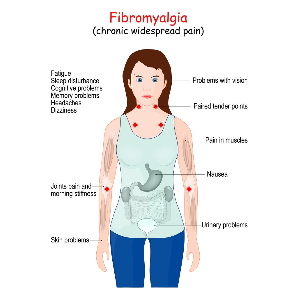 First signs of fibromyalgia.