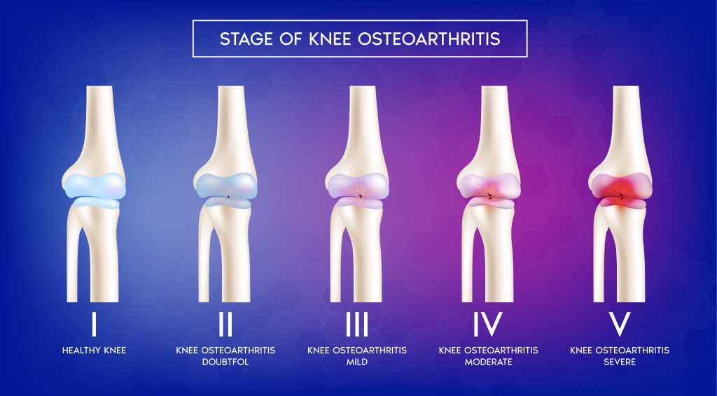 Illustration of the five stages of knee osteoarthritis.
