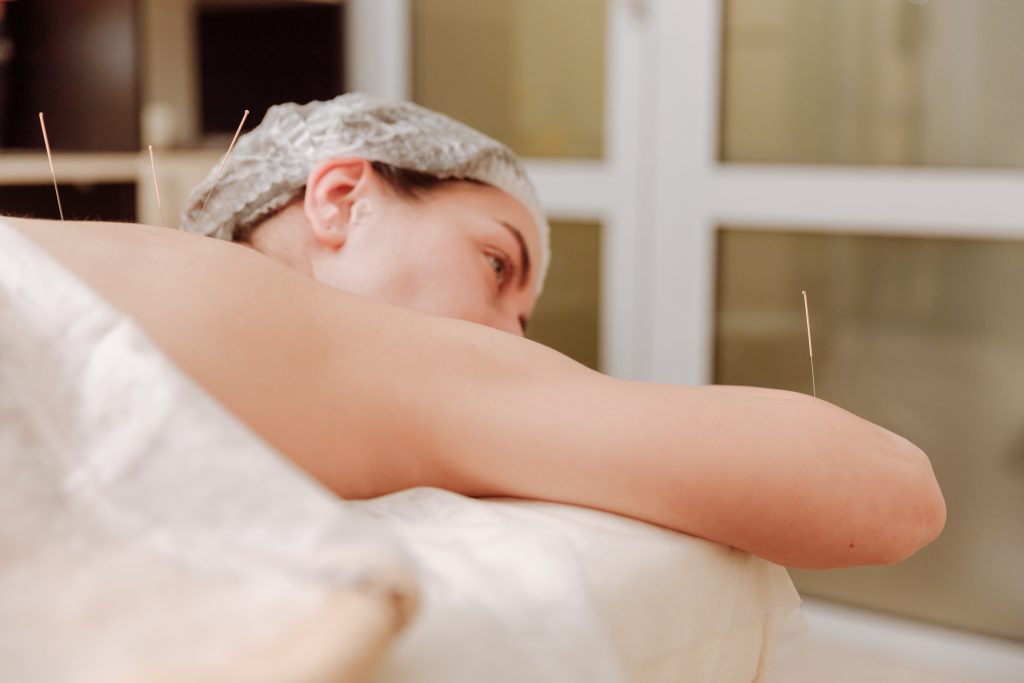 Woman receiving acupuncture therapy for myofascial pain syndrome.