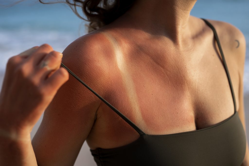 A woman has a wicked sunburn on her chest