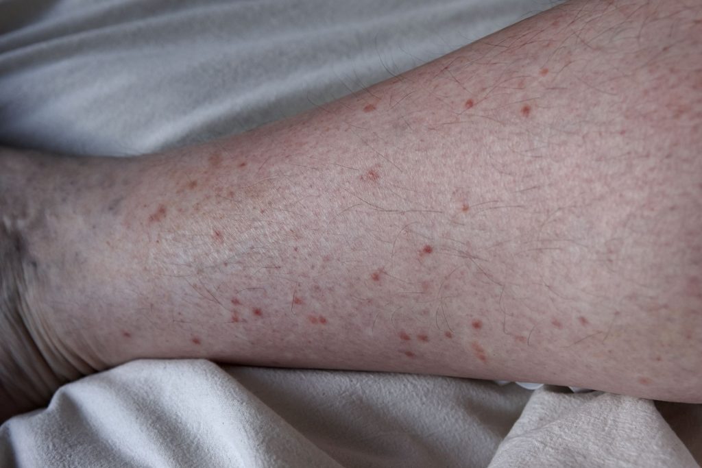 A person's lower leg is full of bug bites