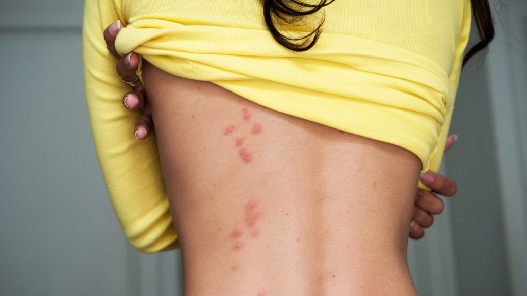 A person is raising their yellow shirt, showing a back full of bug bites