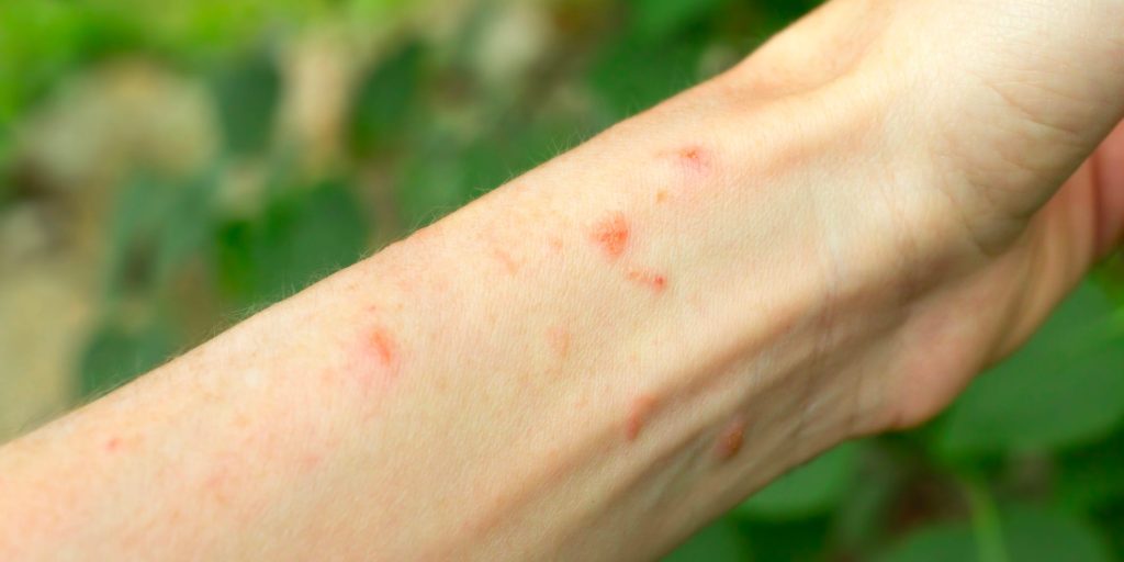 A person is showing their case of poison ivy on their forearm while they're outside