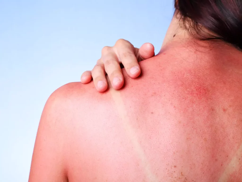 A woman is showing the sunburn on her back with even the marks left from her top