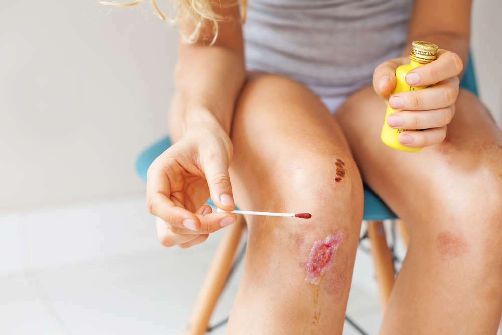 A kid is putting a kind of iodophor (povidone-iodine) on a scrape on their knee with a cotton swab while sitting down on a chair and holding the bottle of antiseptic 