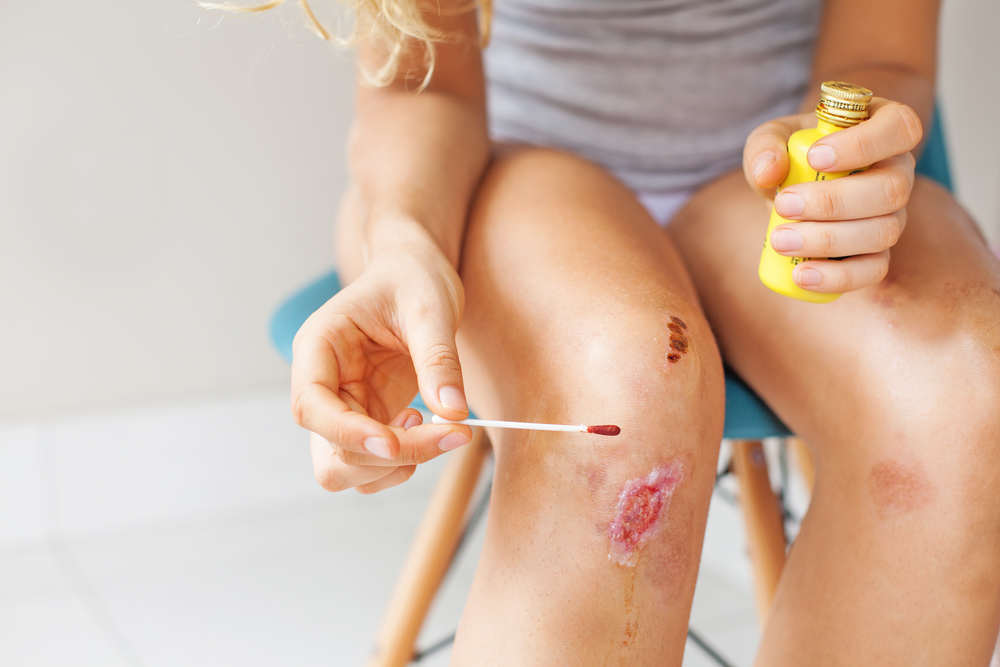 A kid is putting a kind of iodophor (povidone-iodine) on a scrape on their knee with a cotton swab while sitting down on a chair and holding the bottle of antiseptic