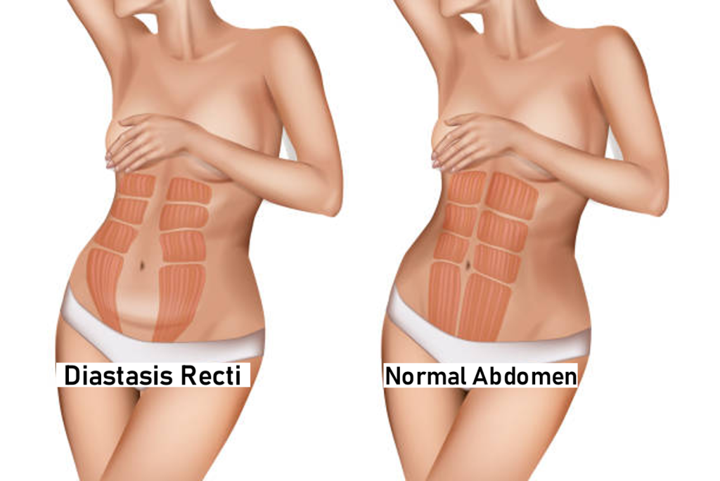 Diastasis Recti: Causes, Symptoms, And Treatment - GulfPhysio - UAE's  Online Physiotherapy Store