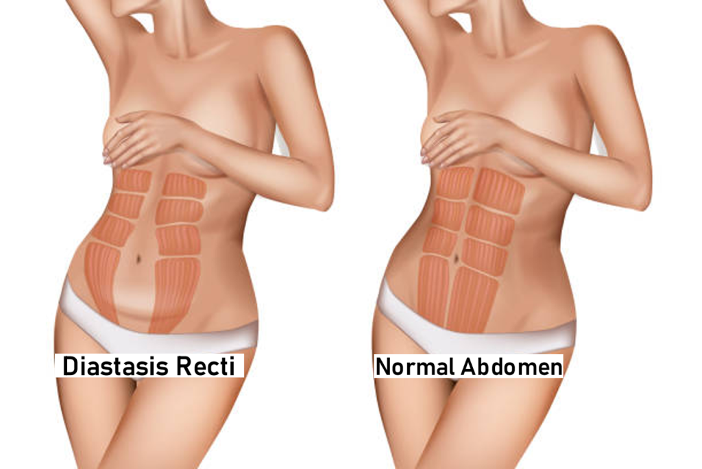 Diastasis Recti ( Abdominal Separation ) - PhysioCare