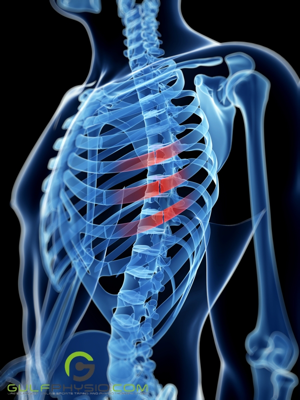 A digitally recreated image of broken rib bones after receiving CPR.