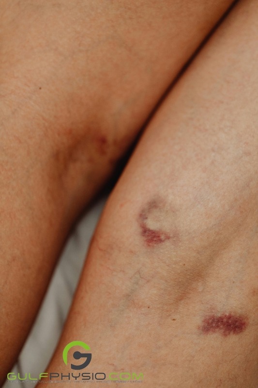 A close-up photo of bruises located at the back of the subject’s leg, directly behind the knee.