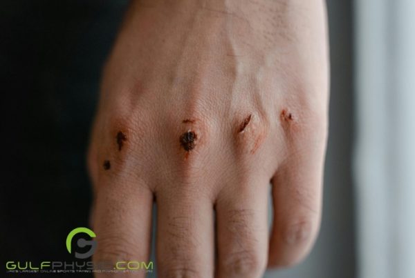 A close-up photo of a wounded hand. The knuckles are cut up and bruised, with scabs beginning to form over the open wounds.