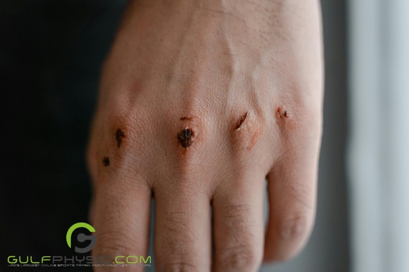 A close-up photo of a wounded hand. The knuckles are cut up and bruised, with scabs beginning to form over the open wounds.
