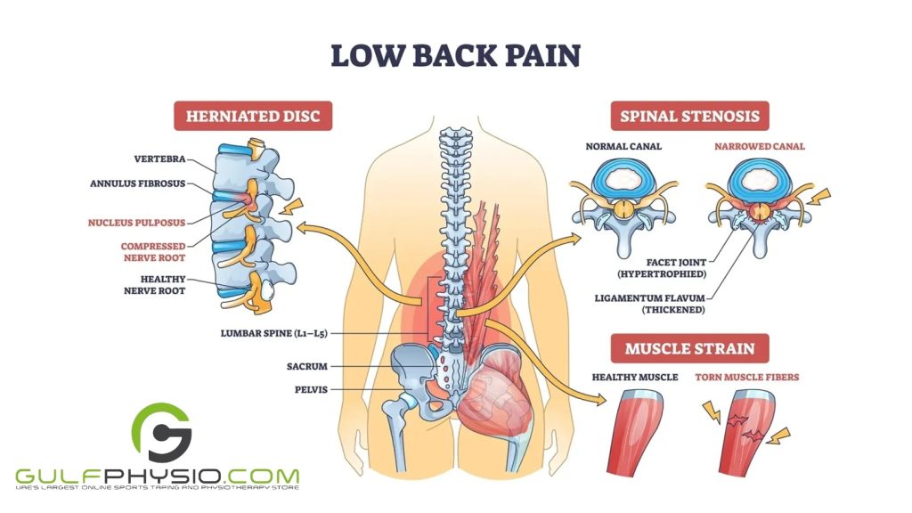 A diagram depicting areas affected by lower back pain.