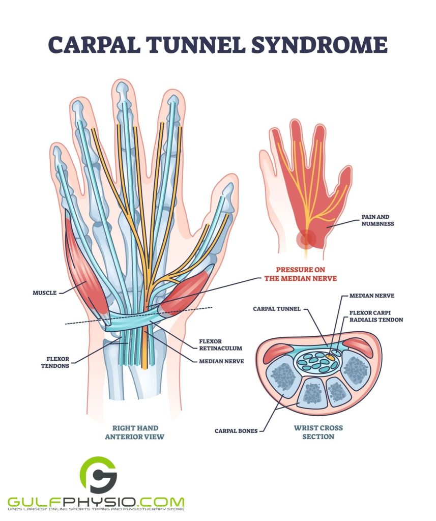 A diagram of the areas affected by Carpal Tunnel Syndrome.