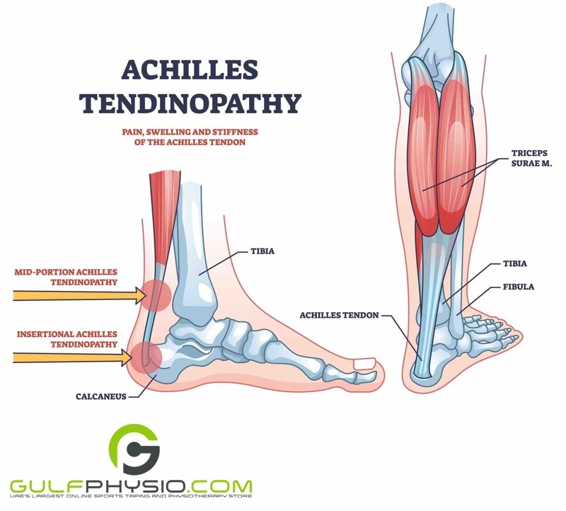 An image of tendonitis (tendinopathy) in the Achilles tendon.