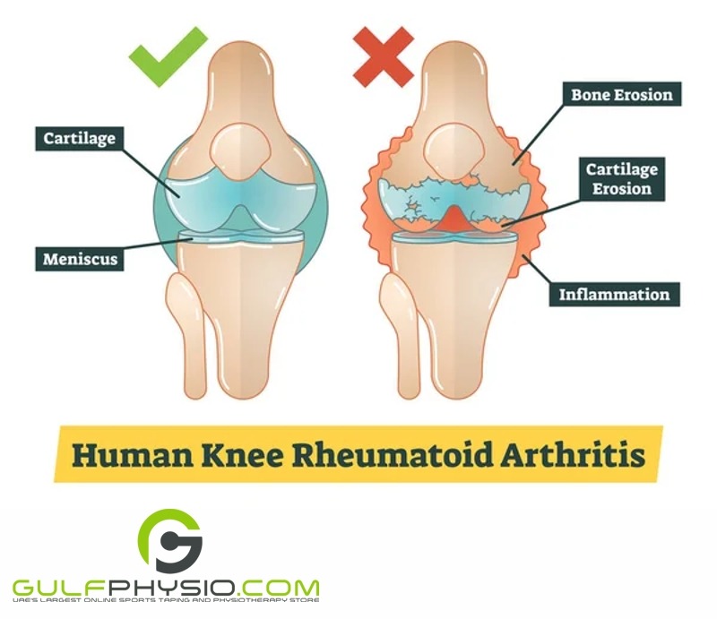 A diagram depicting the area affected by Rheumatoid Arthritis in the human knee.